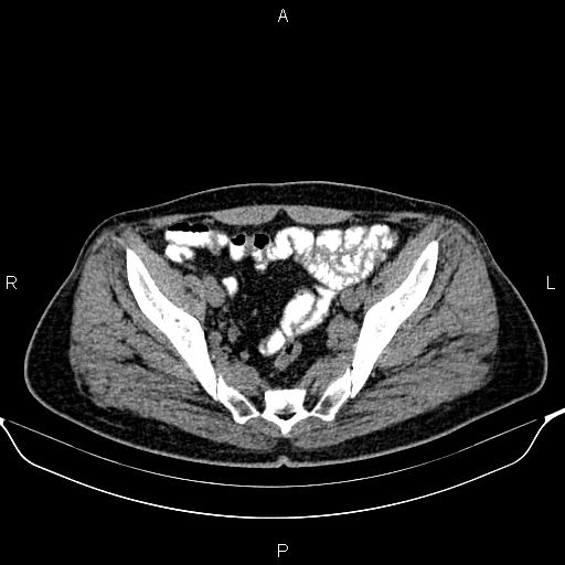 Cecal adenocarcinoma (Radiopaedia 85324-100916 Axial non-contrast 82).jpg