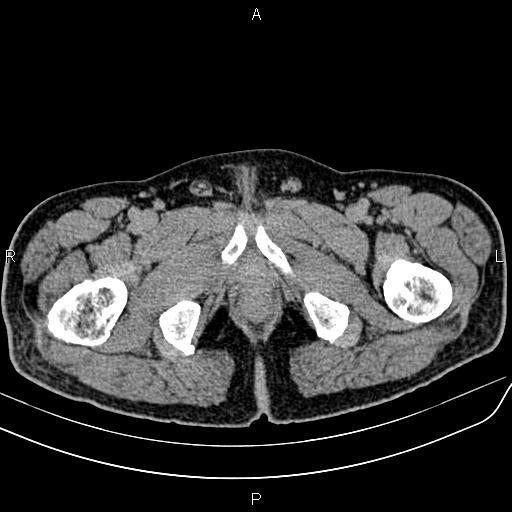 File:Cecal cancer with appendiceal mucocele (Radiopaedia 91080-108651 Axial C+ delayed 91).jpg