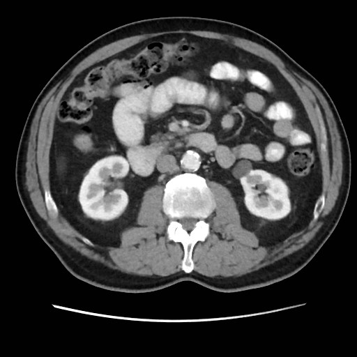 Cecal mass causing appendicitis (Radiopaedia 59207-66531 A 40).jpg