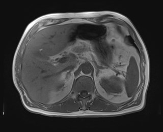File:Cecal mass causing appendicitis (Radiopaedia 59207-66532 Axial T1 in-phase 41).jpg