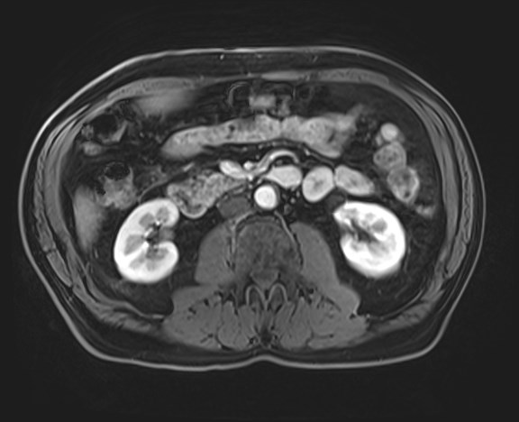 Cecal mass causing appendicitis (Radiopaedia 59207-66532 H 67).jpg