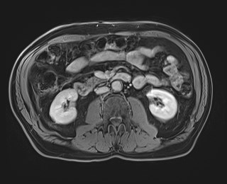 Cecal mass causing appendicitis (Radiopaedia 59207-66532 J 67).jpg