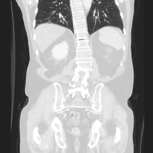 Cecal volvulus (Radiopaedia 75378-86620 Coronal lung window 101).jpg