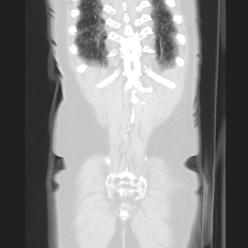 Cecal volvulus (Radiopaedia 75378-86620 Coronal lung window 118).jpg