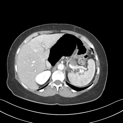 Cecum hernia through the foramen of Winslow (Radiopaedia 46634-51112 A 18).png