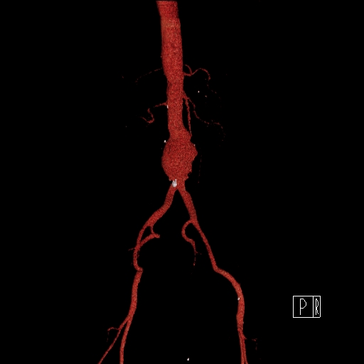 File:Celiac artery compression by the diaphragmatic crurae (Radiopaedia 31739-32666 3D CTA 9).jpg