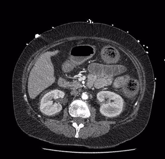 Celiac artery severe stenosis and dissection (Radiopaedia 44128-47842 B 38).jpg