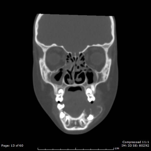File:Central giant cell granuloma (Radiopaedia 45612-49754 Coronal bone window 13).jpg