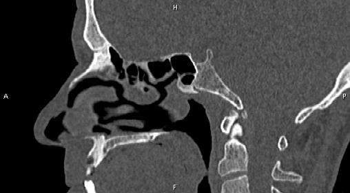 File:Central giant cell granuloma (Radiopaedia 83346-97761 Sagittal bone window 23).jpg