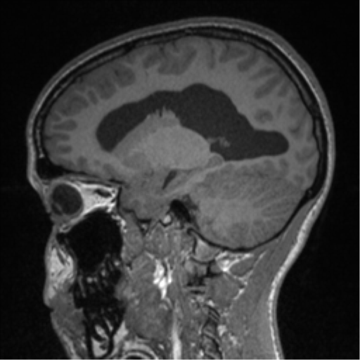 Central neurocytoma (Radiopaedia 37664-39557 Sagittal T1 36).png