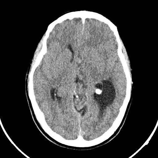 File:Central neurocytoma (Radiopaedia 84497-99871 Axial non-contrast 21).jpg