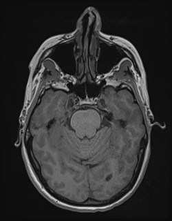 Central neurocytoma (Radiopaedia 84497-99872 Axial T1 67).jpg
