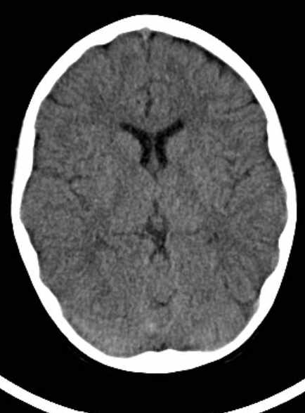 Cerebellar abscess (Radiopaedia 73727-84527 Axial non-contrast 39).jpg