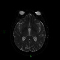File:Cerebellar abscess (Radiopaedia 78135-90678 Axial DWI 46).jpg