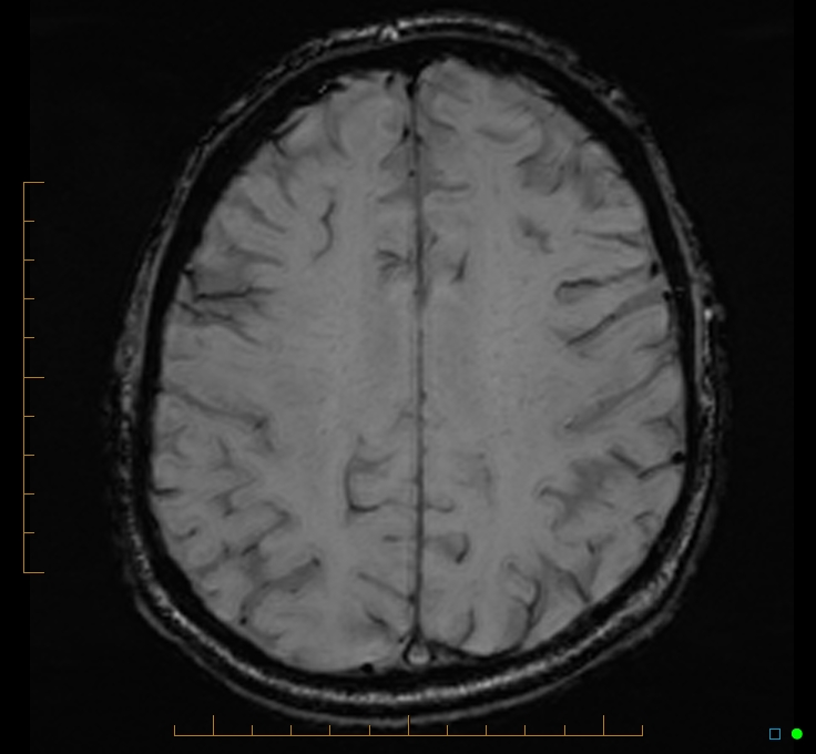 Cerebellar gangliocytoma (Radiopaedia 65377-74422 Axial SWI 42).jpg