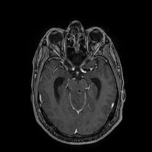 File:Cerebellar hemangioblastoma (Radiopaedia 88055-104622 Axial T1 C+ 79).jpg