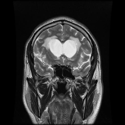 File:Cerebellar hemangioblastoma (Radiopaedia 88055-104622 Coronal T2 3).jpg