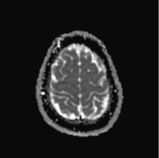 File:Cerebellar hemangioblastomas and pituitary adenoma (Radiopaedia 85490-101176 Axial ADC 30).png