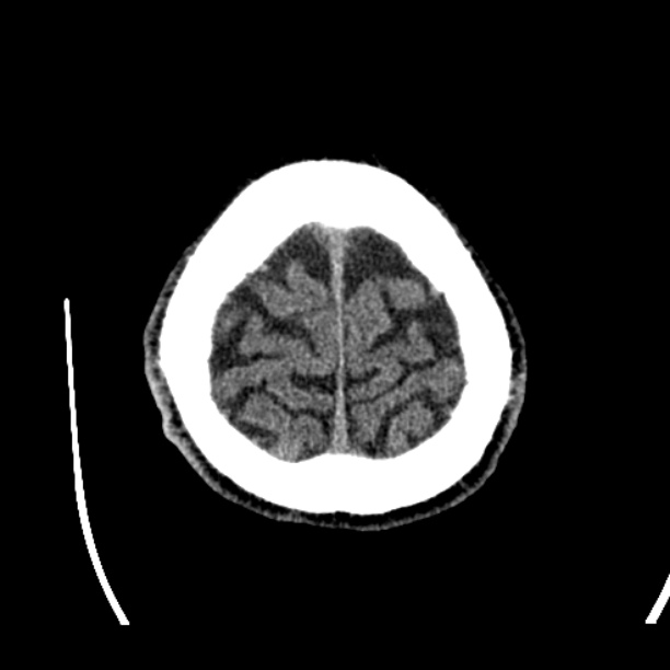 Cerebellar hemorrhage (Radiopaedia 27193-27359 Axial non-contrast 50).jpg
