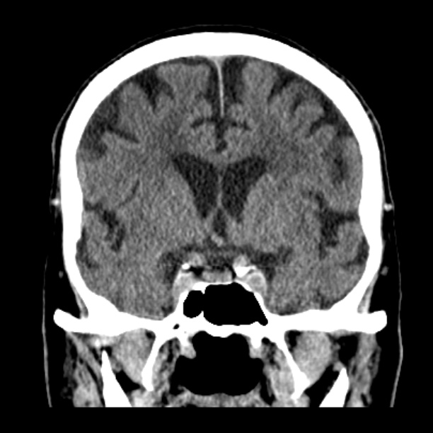 Cerebellar hemorrhage (Radiopaedia 27193-27359 Coronal non-contrast 25).jpg