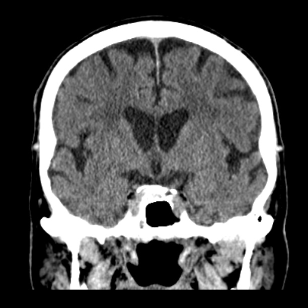 Cerebellar hemorrhage (Radiopaedia 27193-27359 Coronal non-contrast 27).jpg