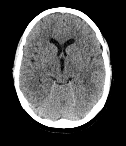 Cerebellar metastases - colorectal adenocarcinoma (Radiopaedia 40947-43652 Axial non-contrast 28).png