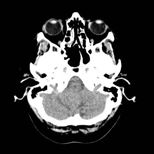 Cerebellar metastasis (Radiopaedia 54578-60812 Axial non-contrast 9).png