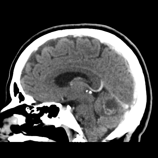 File:Cerebellar metastasis (cystic appearance) (Radiopaedia 41395-44258 F 26).png