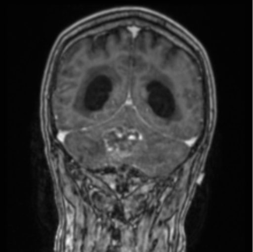 File:Cerebellar metastasis from lung adenocarcinoma (Radiopaedia 86690-102829 Coronal T1 C+ 31).png