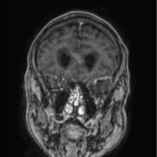 Cerebellar metastasis from lung adenocarcinoma (Radiopaedia 86690-102829 Coronal T1 C+ 73).png