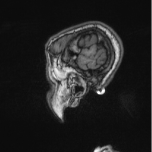 File:Cerebellar metastasis from lung adenocarcinoma (Radiopaedia 86690-102829 Sagittal T1 19).png