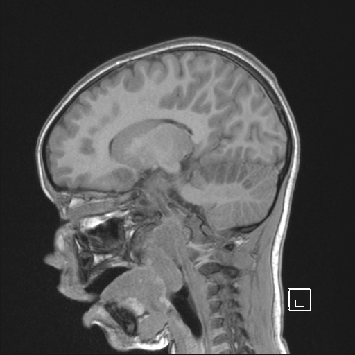 Cerebellar stroke (Radiopaedia 32202-33150 Sagittal T1 C+ 21).png