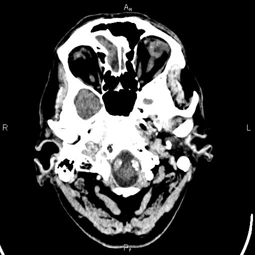 Cerebellopontine angle arachnoid cyst (Radiopaedia 85149-100704 Axial With contrast 2).jpg