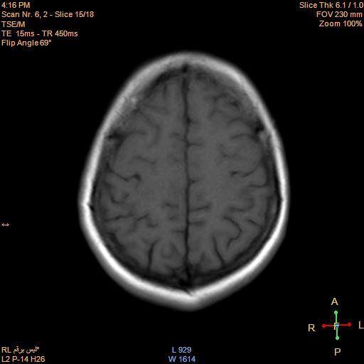 File:Cerebellopontine angle meningioma (Radiopaedia 22488-22525 Axial T1 14).jpg