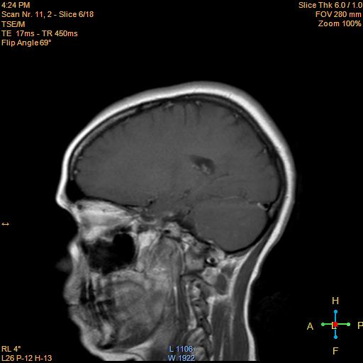 File:Cerebellopontine angle meningioma (Radiopaedia 22488-22525 Sagittal T1 C+ 6).jpg