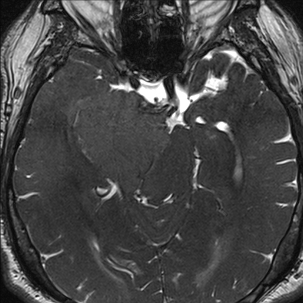 Cerebellopontine angle meningioma (Radiopaedia 24459-24764 I 36).jpg