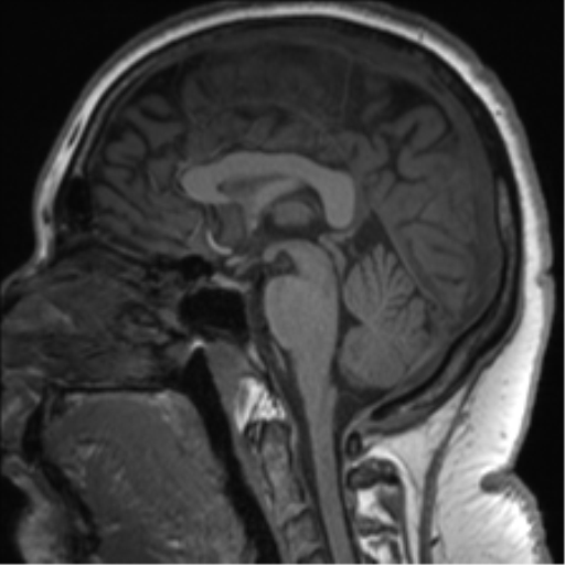 File:Cerebellopontine angle meningioma (Radiopaedia 48434-53348 Sagittal T1 47).png