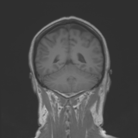 File:Cerebellopontine angle meningioma (Radiopaedia 53561-59591 Coronal T1 17).jpg
