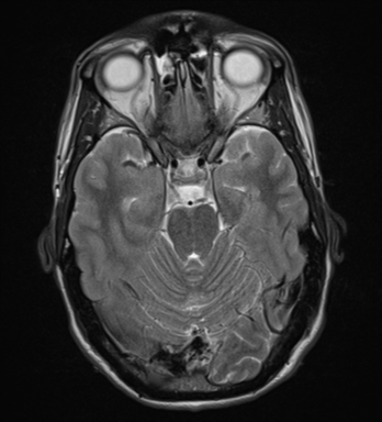 File:Cerebral abscess (Radiopaedia 60342-68009 Axial T2 11).png