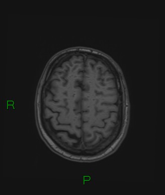 Cerebral abscess and subdural empyema (Radiopaedia 84436-99779 Axial T1 23).jpg