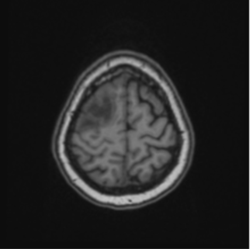 Cerebral abscess from pulmonary arteriovenous malformation (Radiopaedia 86275-102291 Axial T1 64).png