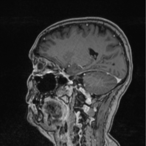 Cerebral abscess from pulmonary arteriovenous malformation (Radiopaedia 86275-102291 Sagittal T1 C+ 30).png