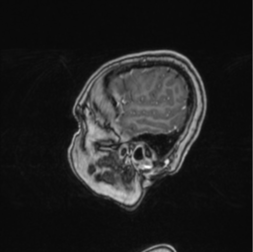 Cerebral abscess from pulmonary arteriovenous malformation (Radiopaedia 86275-102291 Sagittal T1 C+ 68).png
