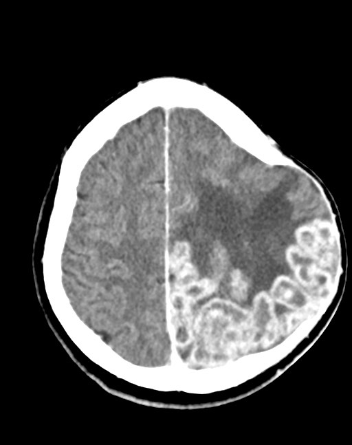 Cerebral abscesses (Radiopaedia 70458-80568 Axial Contrast 47).jpg