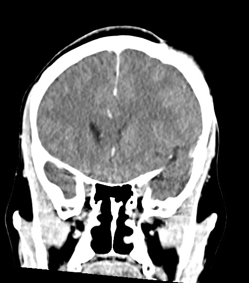 Cerebral abscesses (Radiopaedia 70458-80568 Coronal Contrast 24).jpg