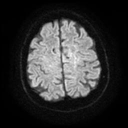 Cerebral amyloid angiopathy (Radiopaedia 28698-28978 Axial DWI 23).jpg