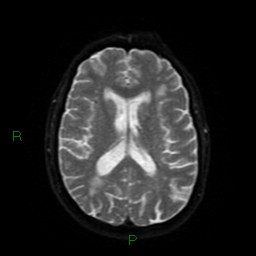 Cerebral amyloid angiopathy (Radiopaedia 77506-89664 Axial DWI 45).jpg