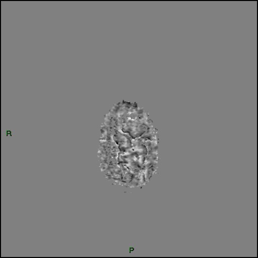 Cerebral amyloid angiopathy (Radiopaedia 77506-89664 H 104).jpg