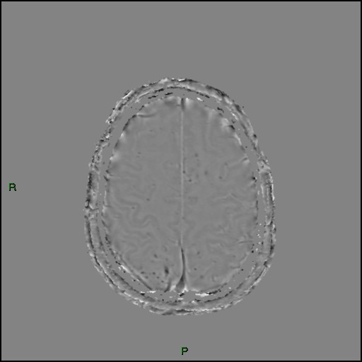 Cerebral amyloid angiopathy (Radiopaedia 77506-89664 H 82).jpg