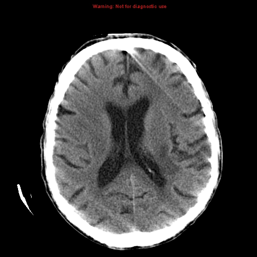 File:Cerebral and orbital tuberculomas (Radiopaedia 13308-13310 Axial non-contrast 17).jpg
